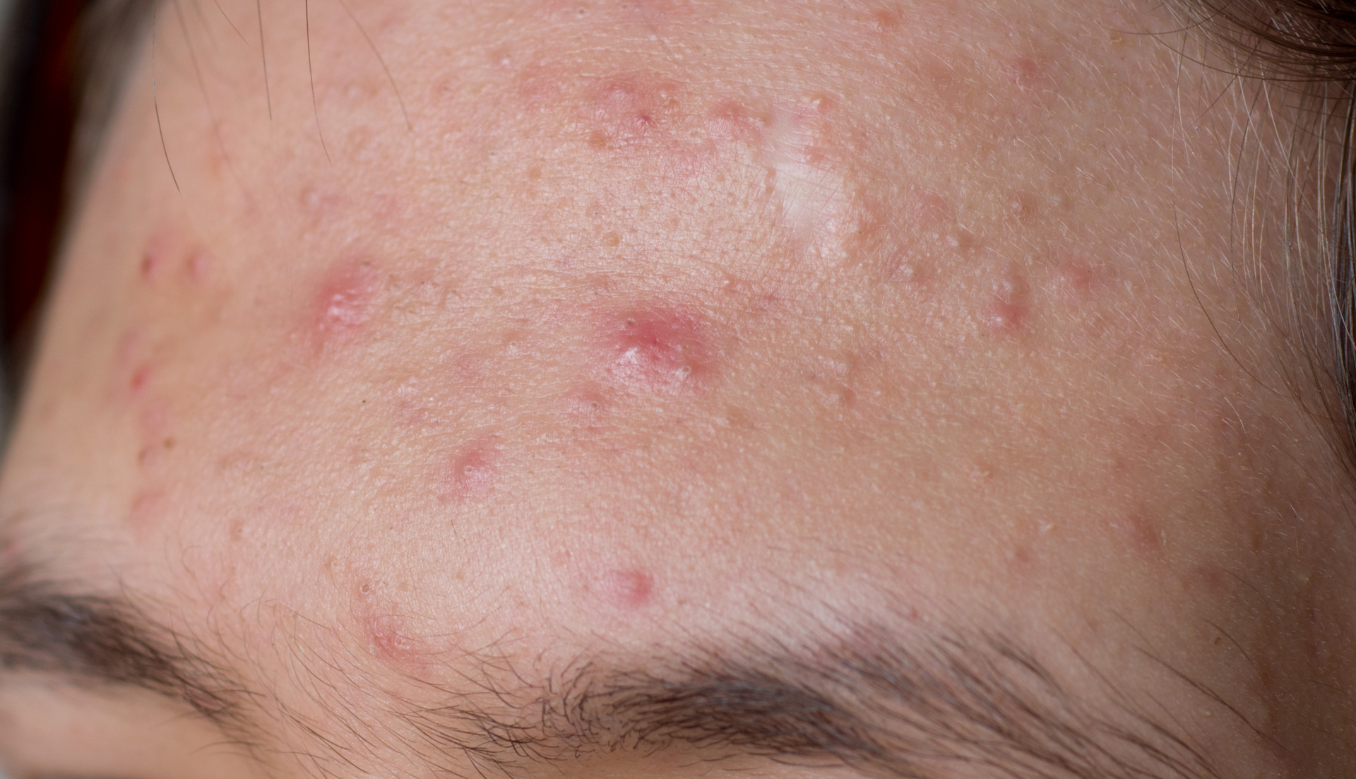 Unreine Haut, Pickel, Akne: In der Behandlung spielt der Wirkstoff Salicylsäure eine große Rolle (© olavs / Fotolia)
